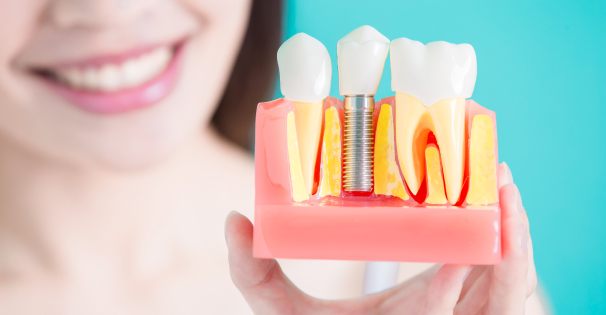 Зубные импланты: основные виды и способы имплантации